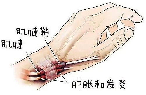 腱鞘炎护拇指CL-A(图1)